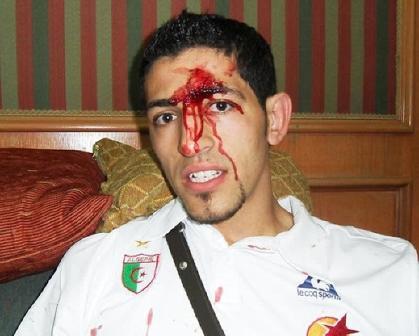 رفيق حليش مصابا في حاجبه بعد الاعتداء على حافلة المنتخب الجزائري في مصر