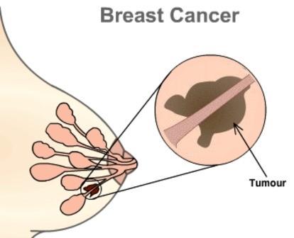 صورة لثدي مصاب بالسرطان