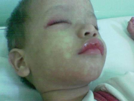 طفل مصاب بالحمى