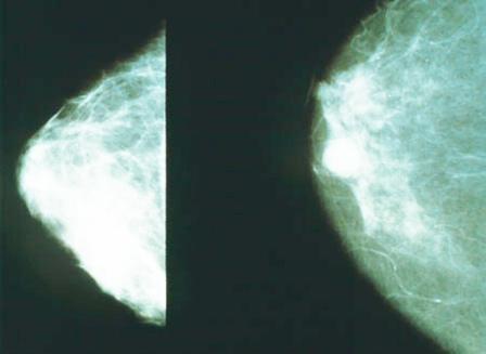 صورة أشعة سينية تبين شكل الورم السرطاني في الثدي(يمين) والثدي الطبيعي(يسار)