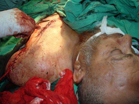 أحد جرحى اعتداءات مليشيات (المشترك) أمس